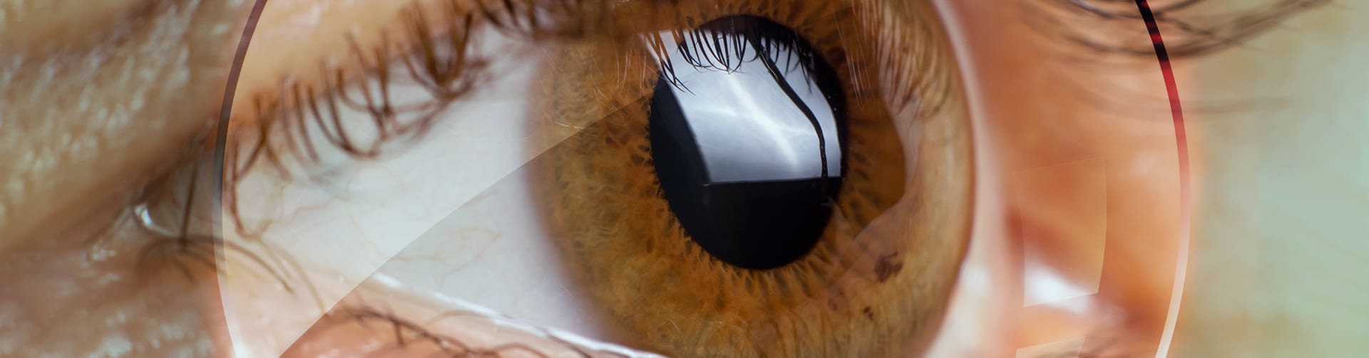 Keratoconus Keratoconus