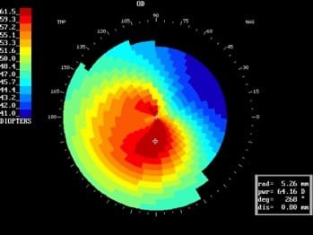 Keratoconic topography