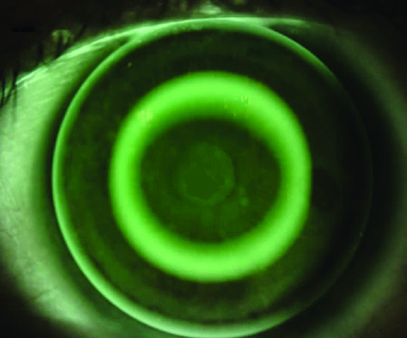 Ideal fitting Ortho-ATX lens