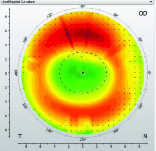 Ideal central flattening