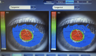 Keratoconus corneal topography both eyes
