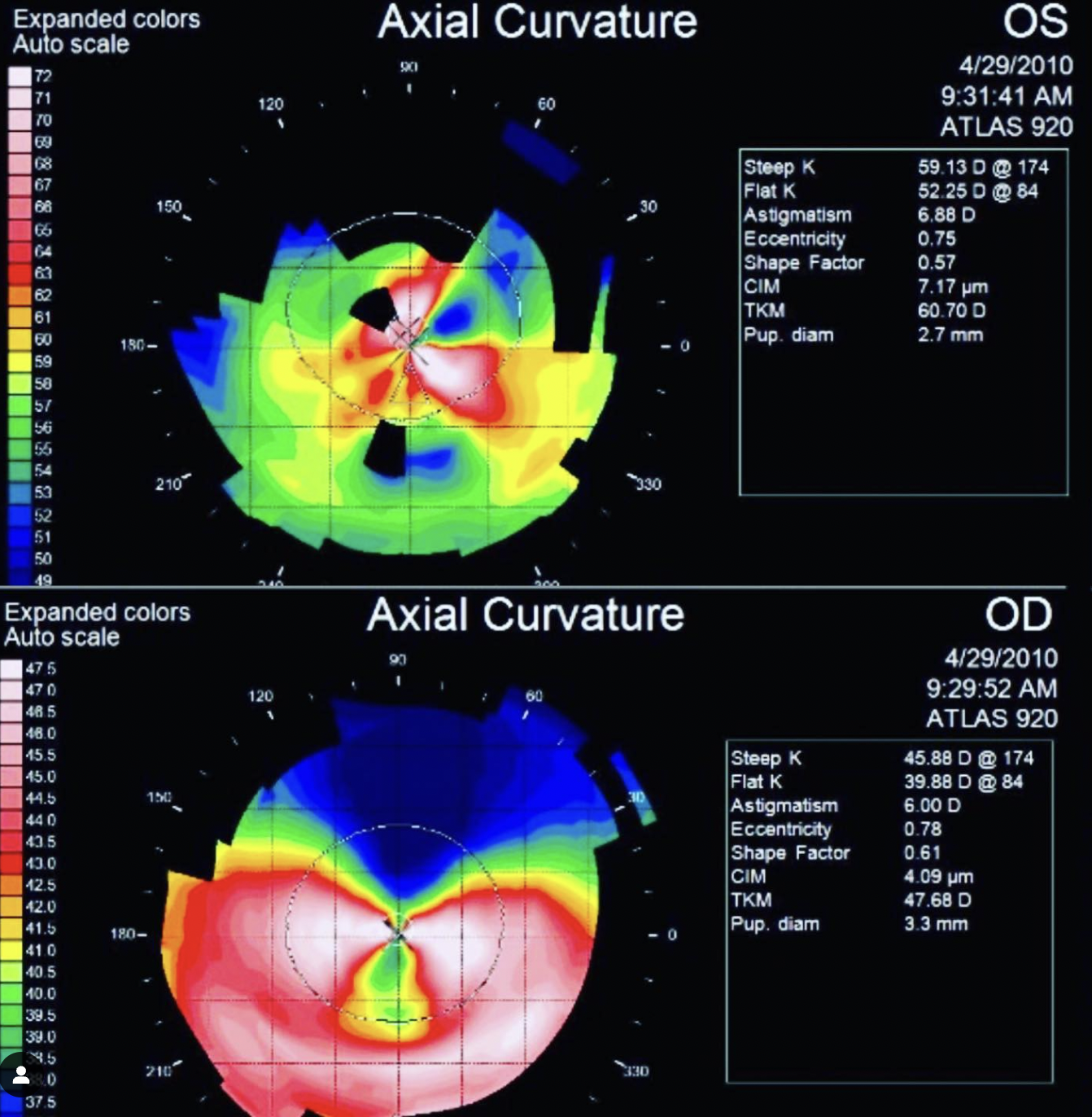 Bilateral Keratoconus KeraSoft Thin Bilateral Keratoconus KeraSoft Thin