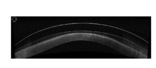 Anterior Seg OCT