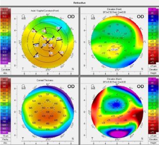 Keratoconus, intacs, crosslinking, ICO